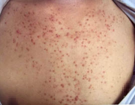 私密地方反复长火疙瘩,揭秘成因与应对策略